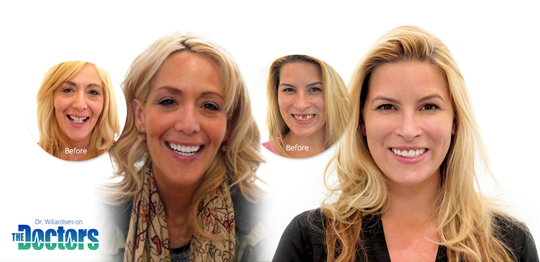 veneers-before-and-afters