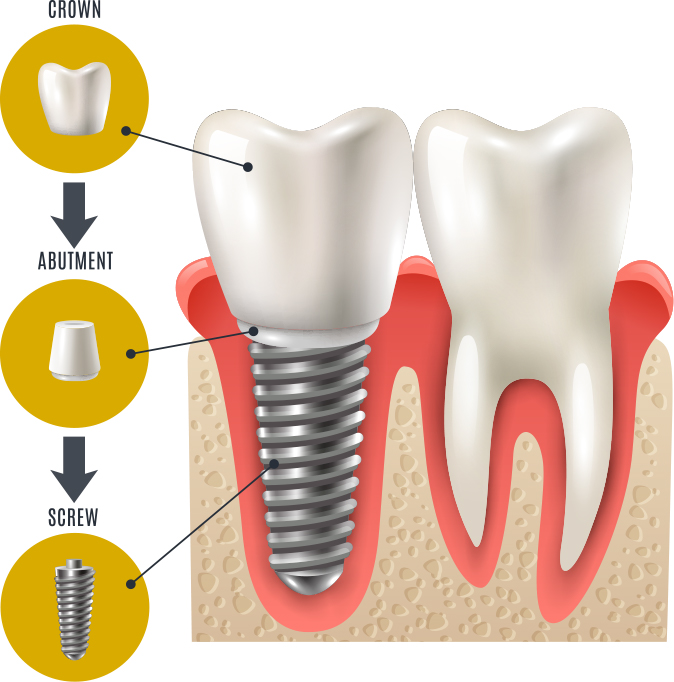 Dental Implants Las Vegas Henderson NV