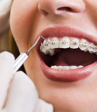 Invisalign Clear Braces Las Vegas Henderson NV