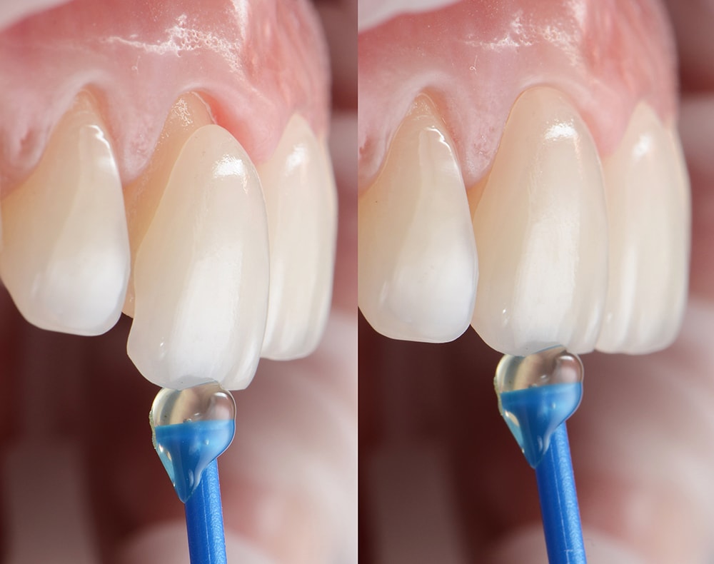 Series shots of dental veneer placement and installation on the tooth.