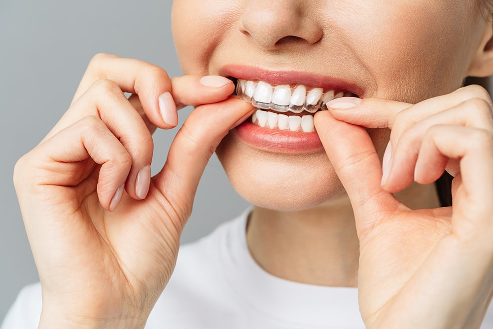 A young woman does a home teeth whitening procedure. Whitening tray with gel