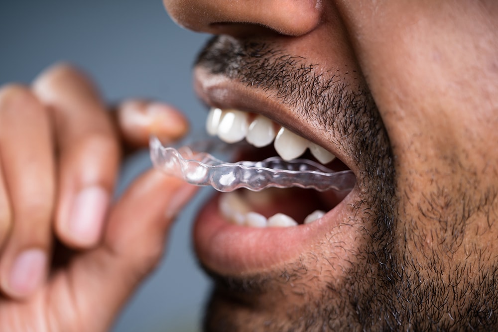 Close-up Of A Man's Hand Putting Transparent Aligner In Teeth