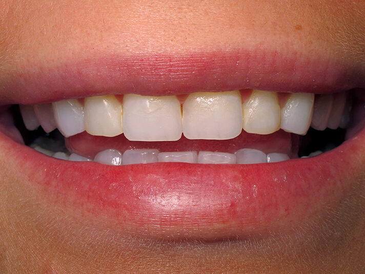 Before