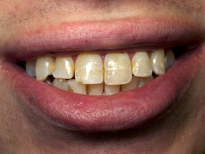 Before